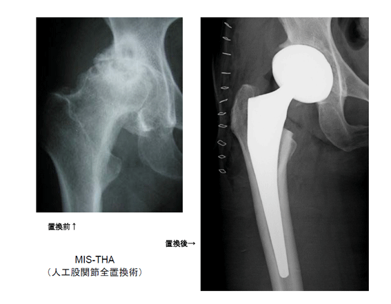 八重瀬会同仁病院整形外科 MIS-THA